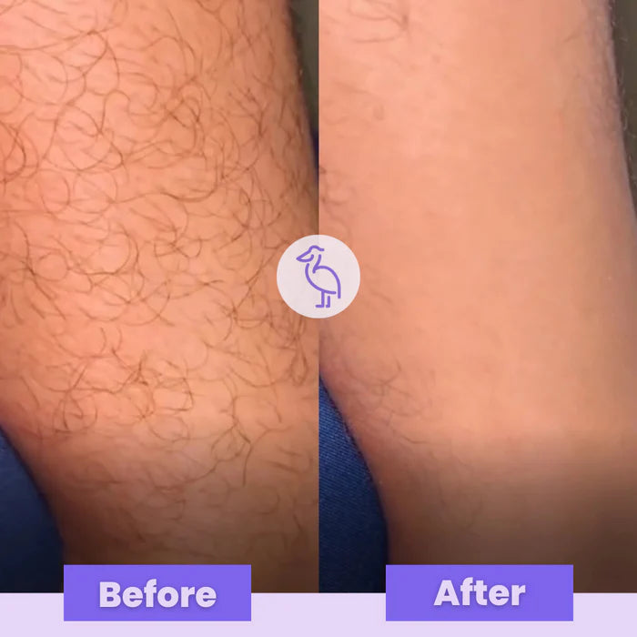 SilkyEraser™ | Remove hair from the roots! - UpLivings