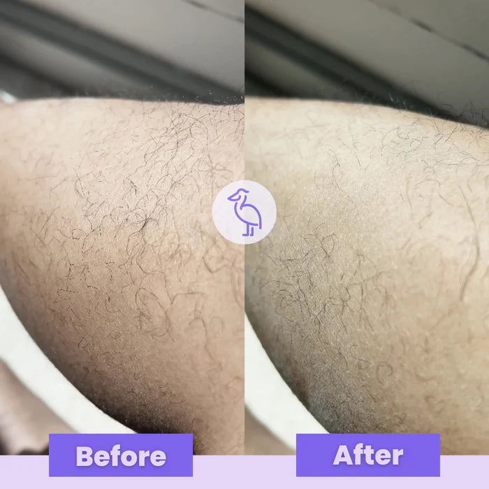 SilkyEraser™ | Remove hair from the roots! - UpLivings